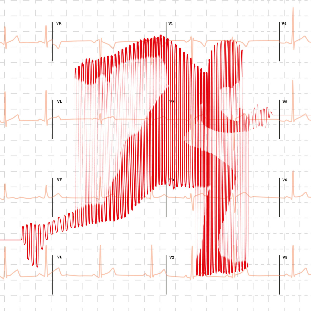 Bioelektronik V - Dem Herzschlag auf der Spur - EKG im Eigenbau